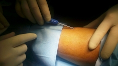 Asp Catanzaro: Lamezia Terme, impiantato un sensore sottocutaneo per il monitoraggio continuo della glicemia in tre giovani diabetici